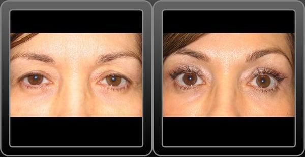 Eyelid Surgery Before & After