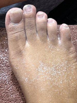 The second toes on each side infected!