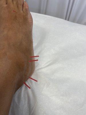 Extra thin needles