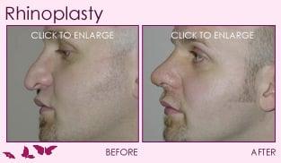 Rhinoplasty, before and after