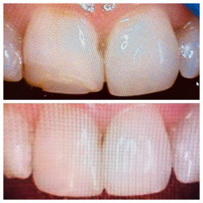 A more conservative tooth bonding and contouring treatment instead of a full crown restoration