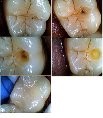 Cavity starts from pits and it can be small on the outside.