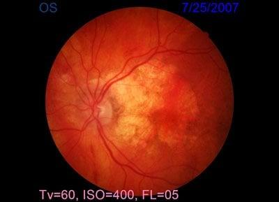 Advanced Macular Degeneration