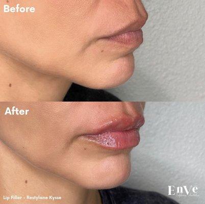 Lip Filler - 1 cc of Restylane Kysse by PA Erin