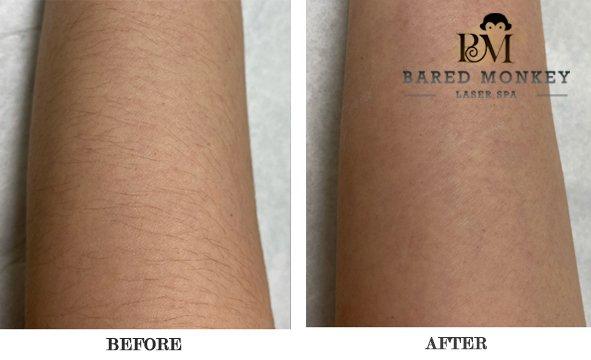 Real result after three Candela Gentle Max Pro Laser hair removal treatments