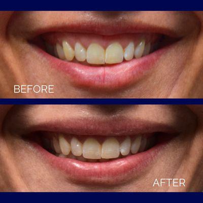 Before & After Gummy Smile Correction with Botox.