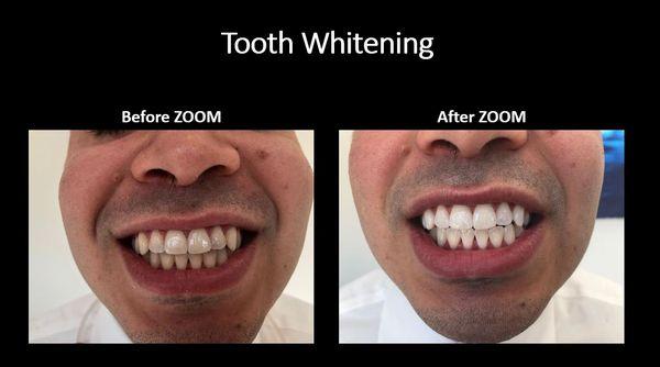 Tooth Whitening Before and After