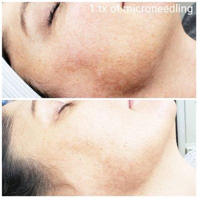 One treatment of microneedling