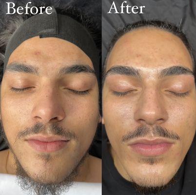 Before and After of client after receiving our "Just for Him Facial"