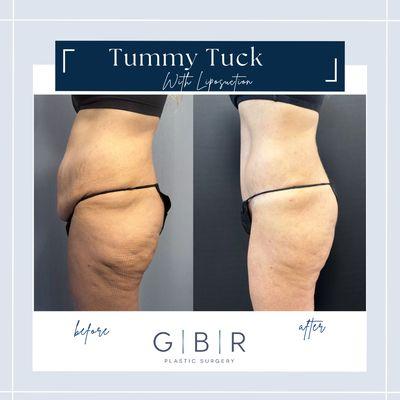 Tummy Tuck with Liposuction Virginia beach