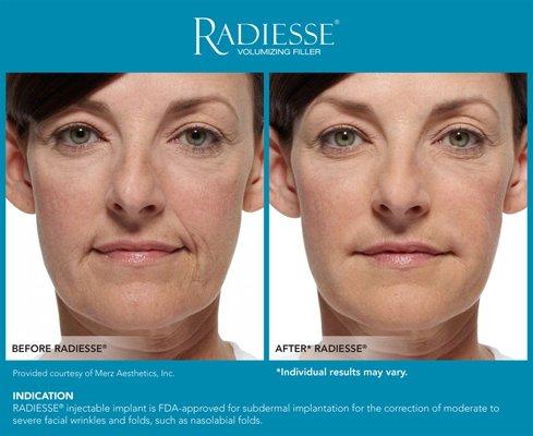 Radiesse Filler Before After. Special promo: buy one get second half off!