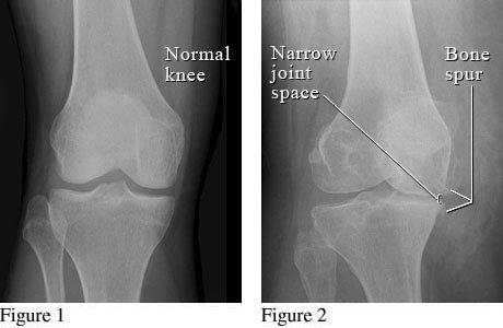 Improve your mobility with natural HA injections