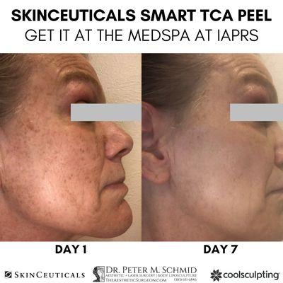 SkinCeuticals Smart TCA Peel Before After by our Licensed Medical Aesthetician