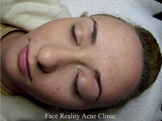 After Treatment from Essentials for Clear Skin - www.essentialsforclearskin.com