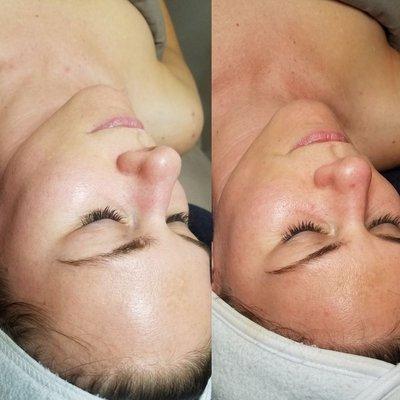 Before and after lactic peel