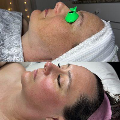 Customized Skin Treatments, SkinPen Microneedling  & Home Care