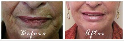 Before and After Juvederm Ultra Plus to the Mouth Area