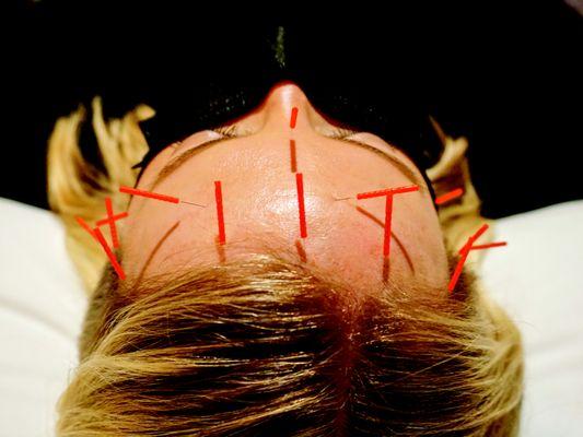 Facial Acupuncture