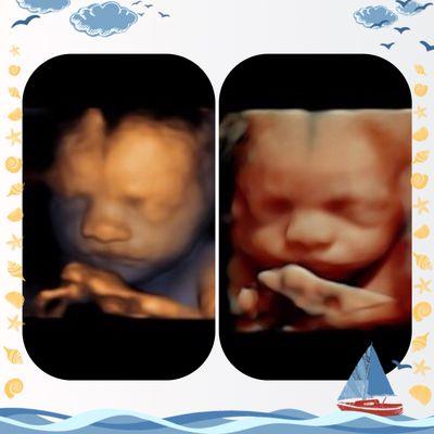 An adorable side-by-side image of one of our babies. Imagine a side-by-side after image of the baby to hang down their nursery wall.