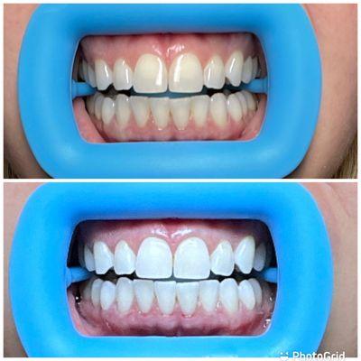 Now offering teeth whitening. Same day appointments available!