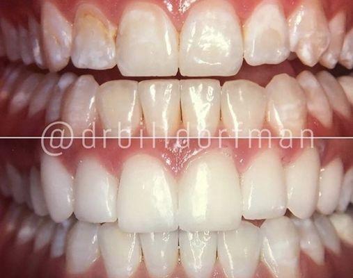 8 upper porcelain veneers and zoom whitening on lower teeth. Low how natural the results are.