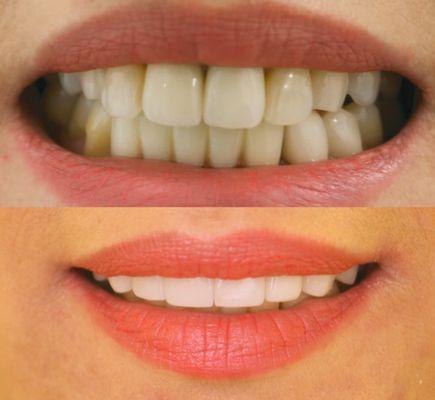 Smile transformation using porcelain dental veneers