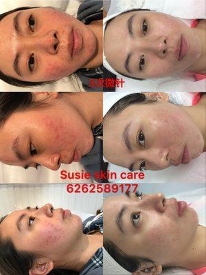 Rocesia treatment