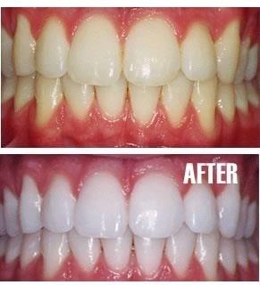 Ask about our "Whitening For Life" program