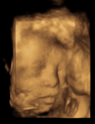 3D Ultrasound photo