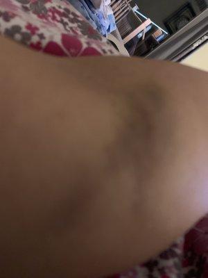 This my second time check out the Bruises in the picture it looks like this person has no experience at all same thing happened to me before