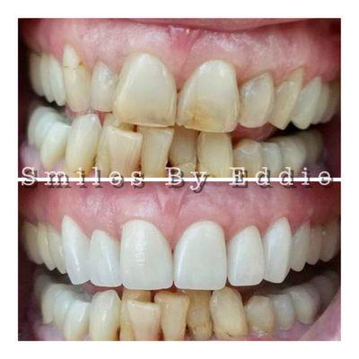 Smile rejuvenation through careful smile design and the use of veneers to start the restoration process for this patient's smile