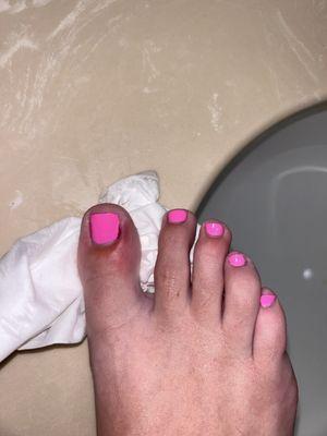 Infected toenail