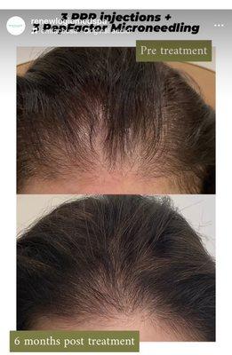 Hair restoration at Renewlogie with PRP injections and Pepfactor microneedling. Series of 3 recommended.