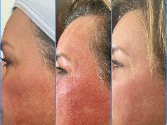 Radio Frequency Microneedling; RF microneedling; microneedling