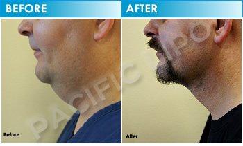 Take years off your look with Chin lipo under local anesthesia. Call Pacific Lipo today!