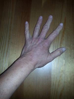 Eczema, after treatment