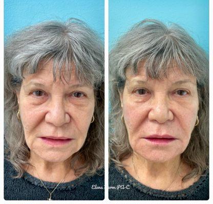 Elena Novak PA-C, used RHA and Versa to transform this patients Cheeks, Nasolabial Folds, Marionette Lines, and Lips.