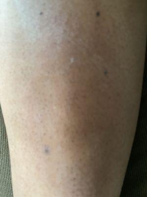 Untreated infection