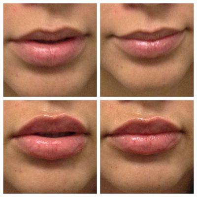 Lip Filler Before & After