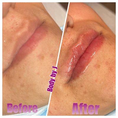 Lip filler Hyaluron treatment