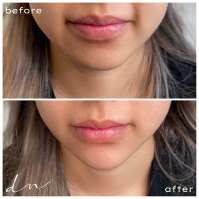 Before and after chin augmentation with fillers