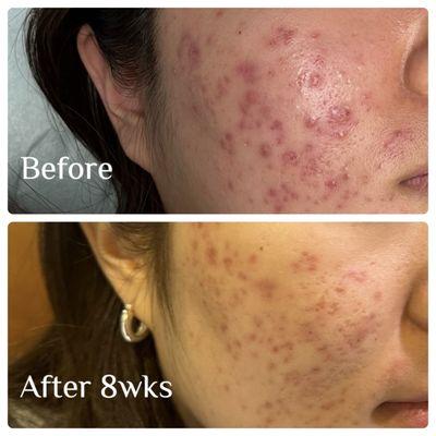 Ask for ACNE treatment. It helps to reduce acne breakouts and rosacea. Our acne patients are also happy with clear and brighter skin tone.