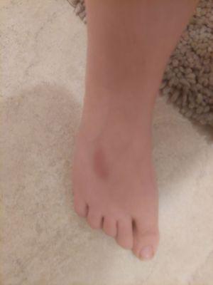 The top of the foot is not a place you want to dig in with a ton of pressure. As a result, I got some bruising.