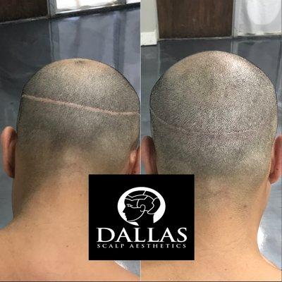 Our Scalp micropigmentation procedures can reduce the appearance of scars.