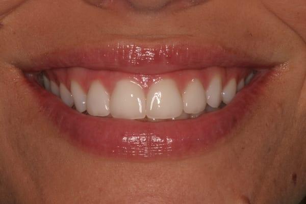 Crowns on 4 front teeth.