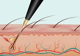 Mariam's Electrolysis 