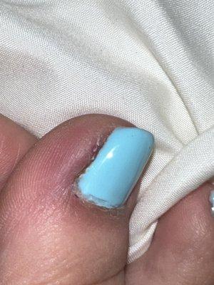 Swelling on the toe