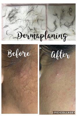 Removing dead skin cells and vellus hairs by dermaplaning