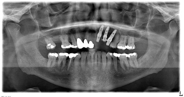 immediate dental implants replacement