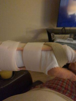 Doin pretty good 5 days after surgery and now in a custom splint built just for me.